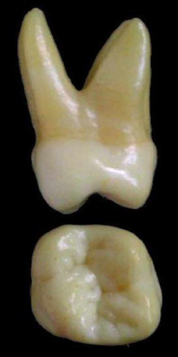 <p>what tooth is this &amp; why?</p>