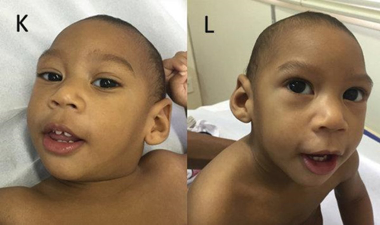 <p>-microcephaly</p><p>-craniofacial dysmorphisms</p><p>-neuromotor abnormalities</p>