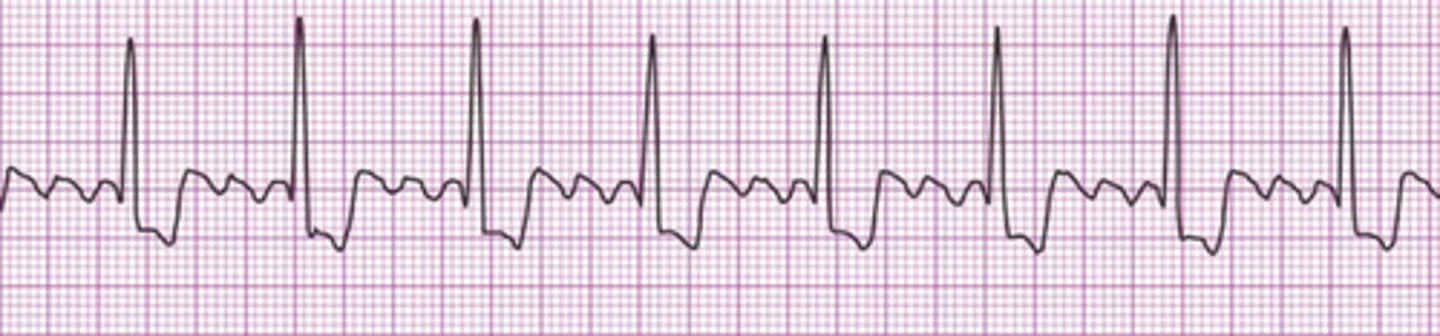 <p>Atrial flutter</p>
