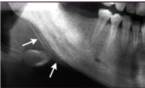 <p>layering of new bone mostly seen in inflammatory lesions and more rarely in tumors </p>