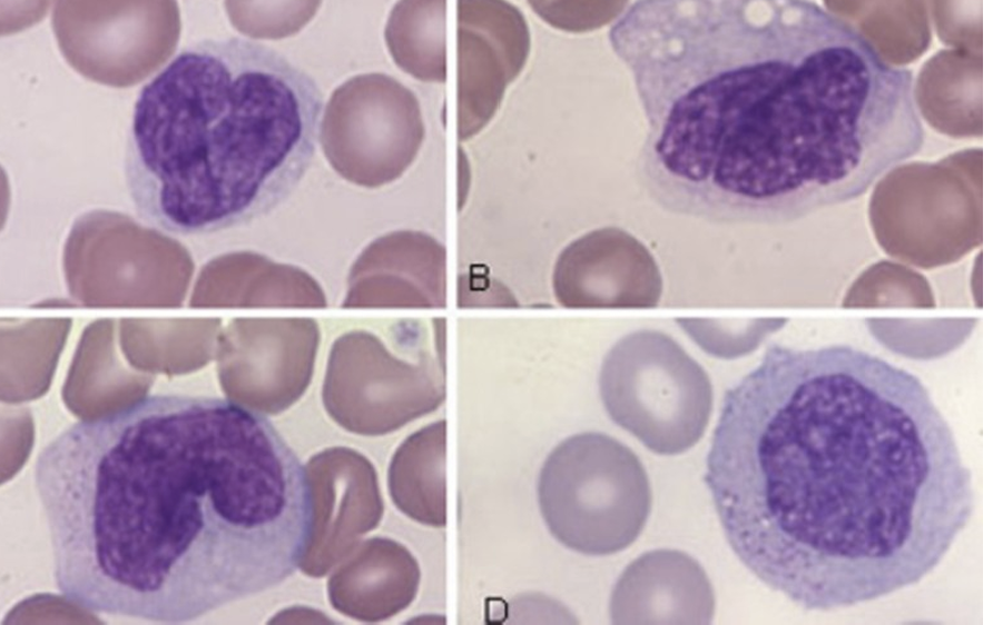 <p>Innate Immunity Cells - Monocytes</p><ul><li><p><strong>Largest WBCs</strong> with a <strong>horseshoe-shaped nucleus</strong> and <strong>gray-blue cytoplasm</strong></p></li><li><p>Contain <strong>digestive vacuoles</strong> and <strong>fine granules</strong></p></li><li><p>Main jobs:</p><ul><li><p><strong>Phagocytosis</strong> (they eat invaders)</p></li><li><p><strong>Release digestive enzymes</strong> to break down what they consume</p></li></ul></li><li><p>They’re <strong>precursors to macrophages</strong> </p><ul><li><p>once monocytes enter tissues, they mature into macrophages (the cleanup crew)</p></li></ul></li></ul><p></p>