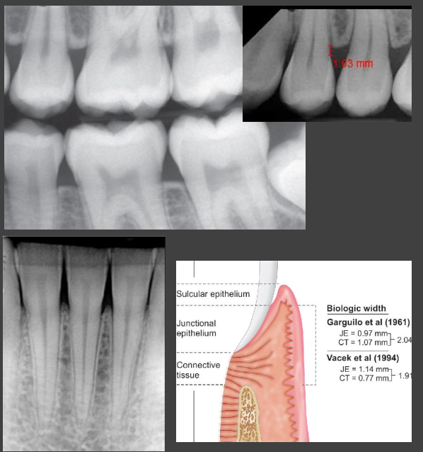 <ul><li><p>Thin layer of radiopaque cortical bone overlying crest</p><ul><li><p>Lack of cortication can be seen both with and without periodontitis</p></li></ul></li><li><p><strong>Crest is 0.5–2.0 mm apical to CEJ</strong></p><ul><li><p>Parallel to imaginary line connecting CEJs of adjacent posterior teeth</p></li><li><p>Peak-like between anterior teeth</p></li></ul></li><li><p>Sharp, well-defined angle between lamina dura and crest</p></li><li><p>Coronal PDL space typically thin and uniform</p><ul><li><p>May appear slightly wider around premolar and erupting teeth</p></li><li><p>If lamina dura forms sharp angle with crest, likely normal</p></li></ul></li><li><p>Increased radiolucency of crest due to thin buccal/lingual thickness</p></li></ul><p></p>