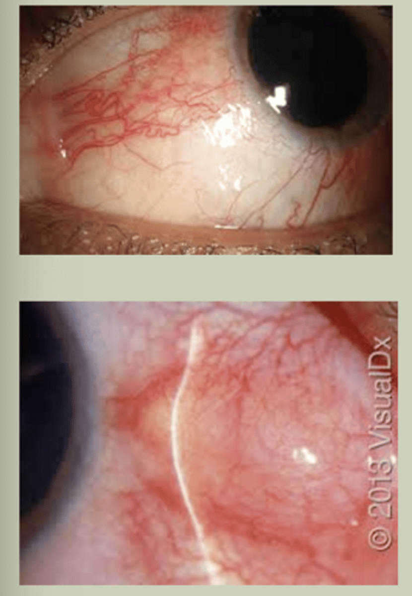 <p>-Sectoral redness, unilateral</p><p>-Mild irritation, discomfort, prickly sensation in eye</p><p>-Does not cause change in vision</p><p>-Progressing cases can indicate collagen-vascular disease</p><p>-Refer to ECP for TX &amp; management</p>