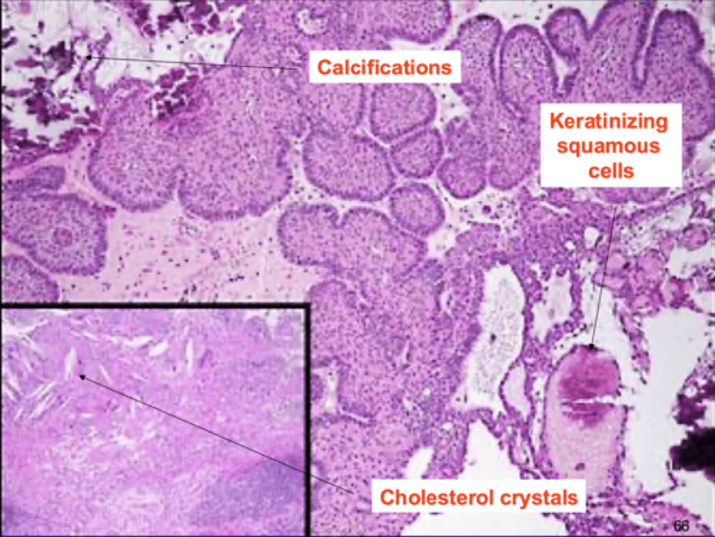 <p>cholesterol crystals</p><p>keratinizing squamous cells</p><p>calcifications</p>