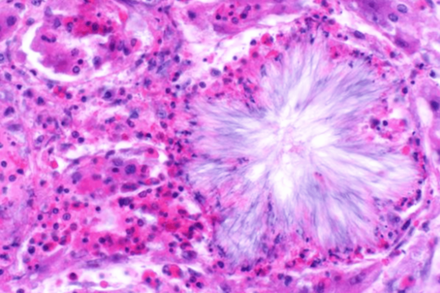 <p>Describe this extracellular accumulation in the kidney</p>