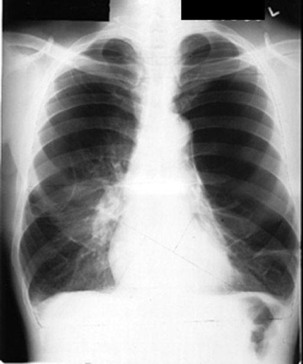 <p>Imaging to rule out other lung diseases.</p>