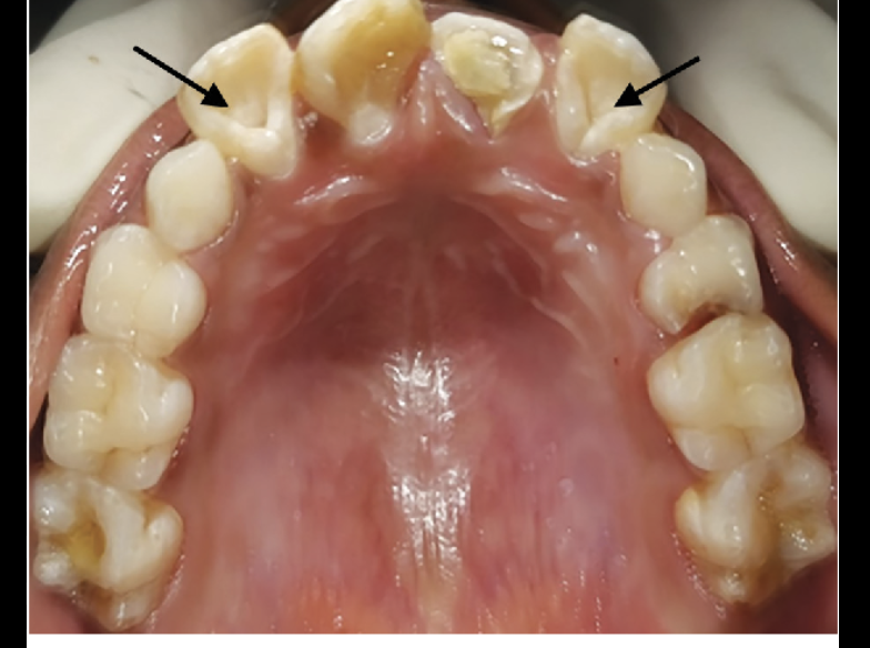 <p>more common in lateral because of lingual pit </p>