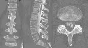 <p>a diagnostic imaging test generally done by a radiologist. It uses a contrast dye and X-rays (fluoroscopy) or computed tomography (CT) to look for problems in the spinal canal. Problems can develop in the spinal cord, nerve roots, and other tissues.</p>