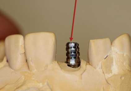 <p>What is the sixth step to fabricating a provisional implant restoration?</p>