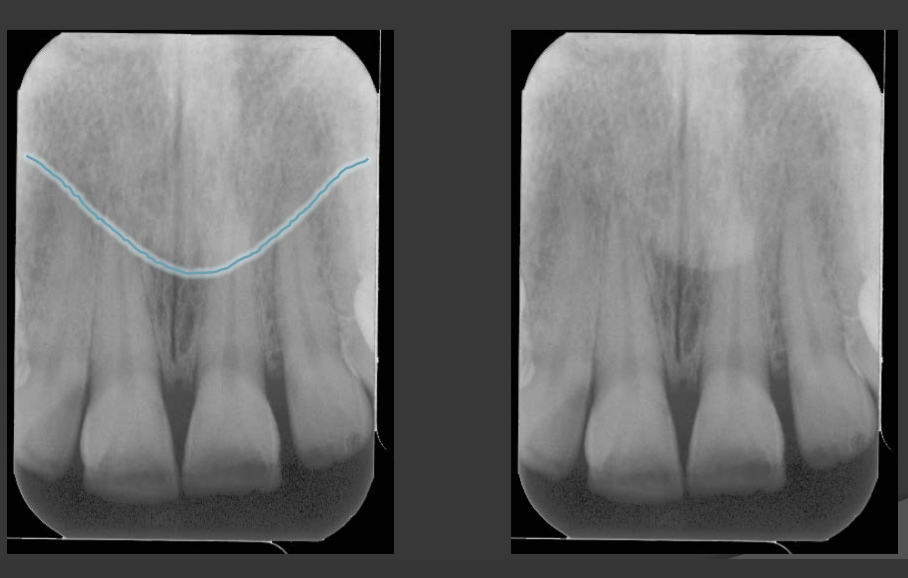 <p>It looks like a light radio opaque V shape that extends down below the anterior nasal spine and overlaps with the roots of the maxillary centrals.</p>
