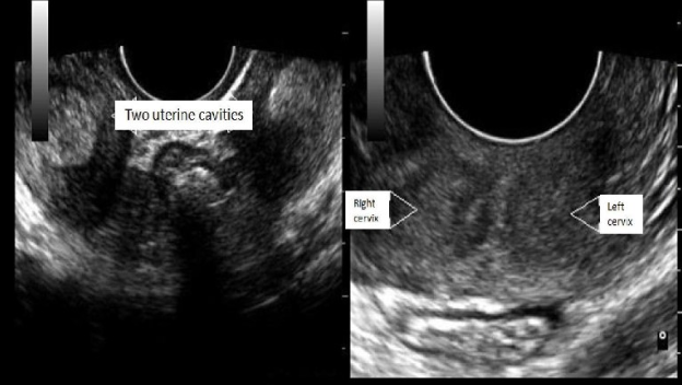 <p>b) a right + left uterine body, cervix, and vaginal canal</p>