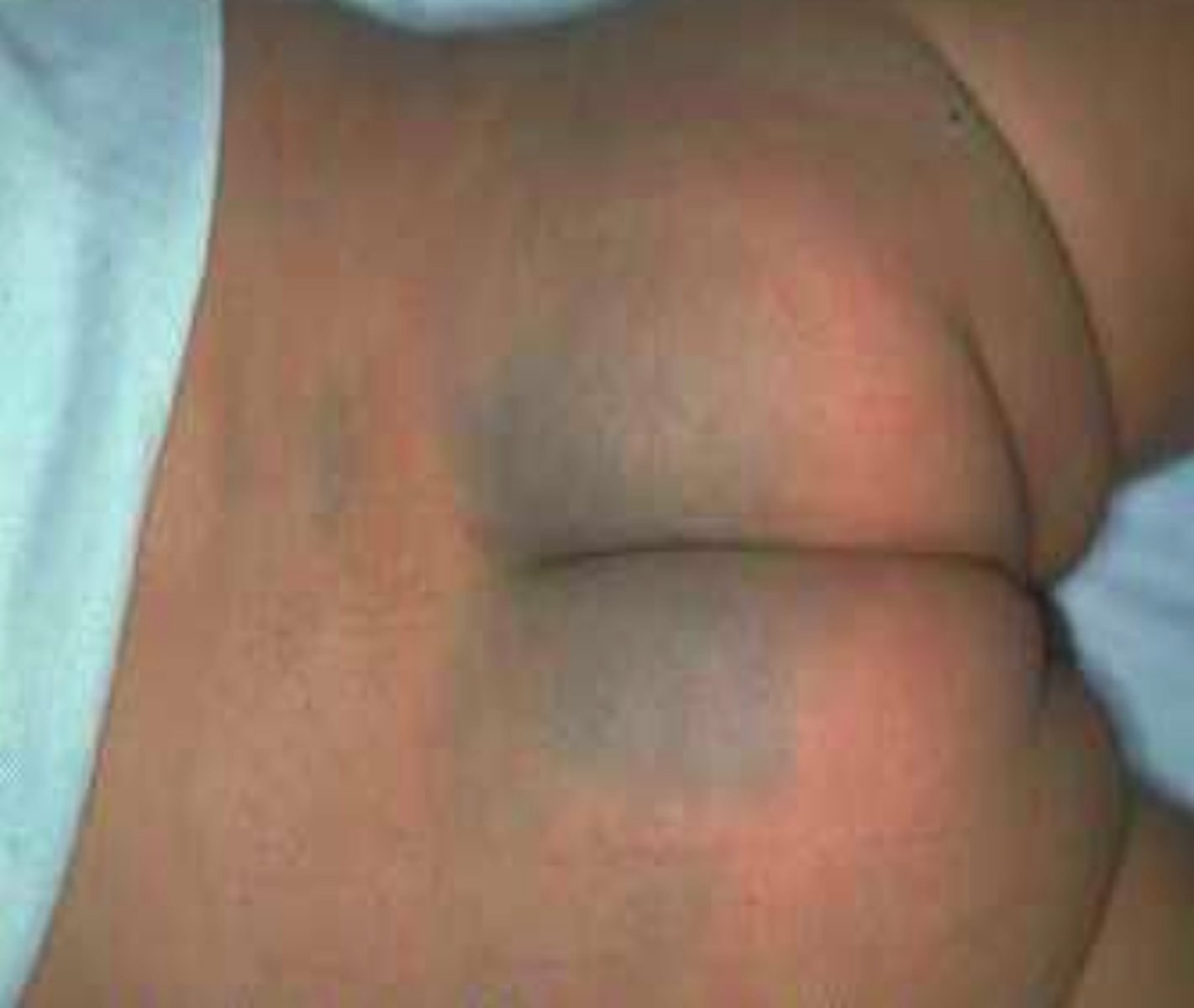 <p>Benign discoloration of bluish gray on buttocks but usually fades</p>