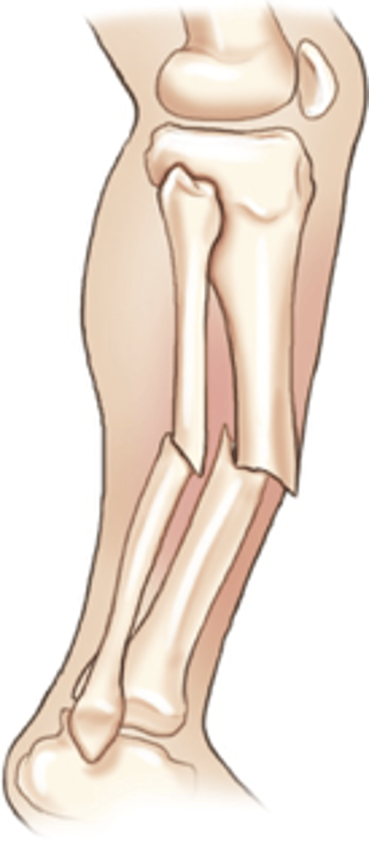 <p>Bone protrudes through skin (an open fracture)</p>