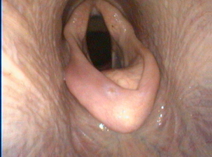 <p>AKP store husdyr blok 3 23/24</p><p>Du foretager en endoskopiundersøgelse af en hest, der har nedsat præstationsevne og respiratorisk bilyd under arbejde. Hvad er din diagnose?</p><p>1 Dorsal dislokation af den bløde gane </p><p>2 Laryngshemiplegia sinistra </p><p>3 Epiglottisentrapment </p><p>4 Laryngshemiplegia dextra</p>