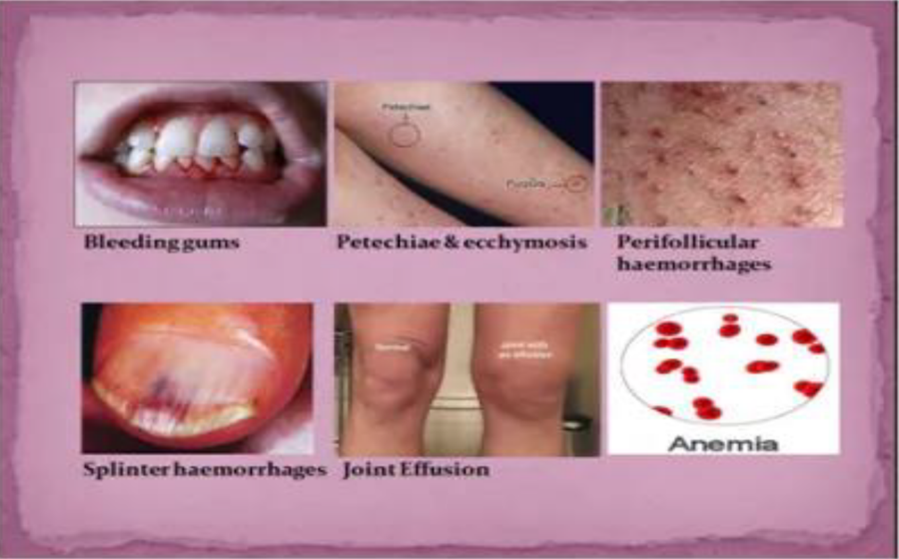 <p><span style="font-family: Century Gothic, sans-serif">bleeding gums, loose teeth, tendency to bruise easily, poor wound healing, and, ultimately scurvy</span></p>