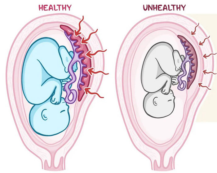 <p>Refers to a fetus that is <strong>at or below the 10th percentile</strong> of expected birth weight for its <strong>gestational age</strong>.</p>