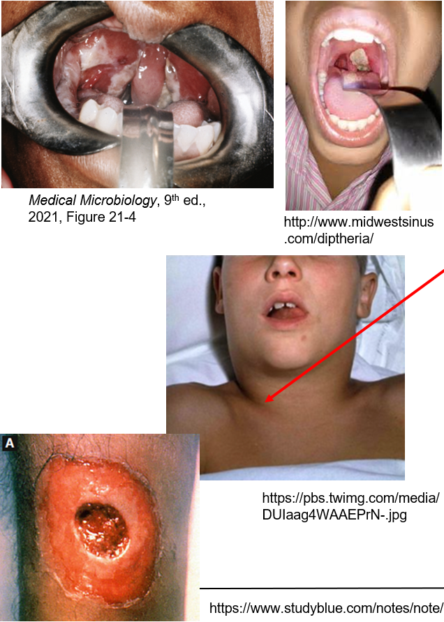 <p>A<strong> grayish-white coating on the tonsils, uvula, or palate</strong> that bleeds when scraped &amp;<strong> “bull neck” (swollen neck).</strong></p>