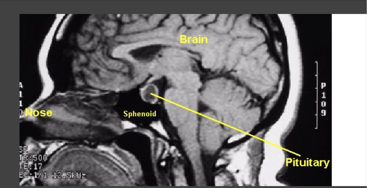 <p>Benign Pituitary Adenoma:</p><ul><li><p>Acromegaly/Giantism = </p></li><li><p>Adult Growth Hormone Deficiency = </p></li><li><p>Cushing’s Syndrome = </p></li><li><p>Diabetes Insipidus = </p></li><li><p>___pituitarism </p></li></ul><p></p><p></p>