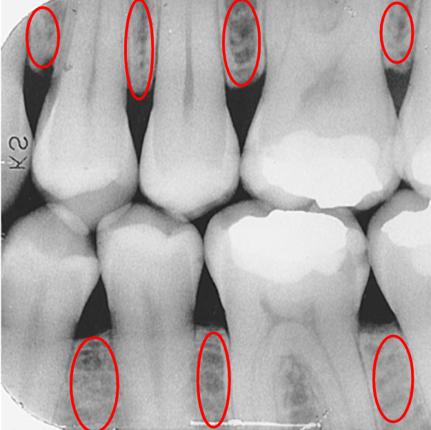 <p>The top edge of the alveolar bone between teeth.</p>