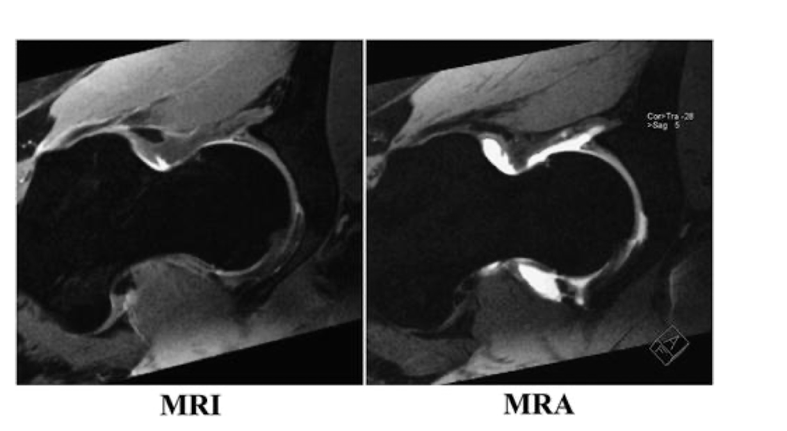 <p>Labral Tear: Diagnosis</p><ul><li><p>An MRI is MORE sensitive than what?</p></li><li><p>An MRA is MORE sensitive than what?</p></li></ul><p></p><p></p>