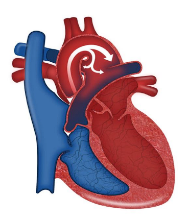 An opening between the pulmonary artery and aorta present in fetal circulation.