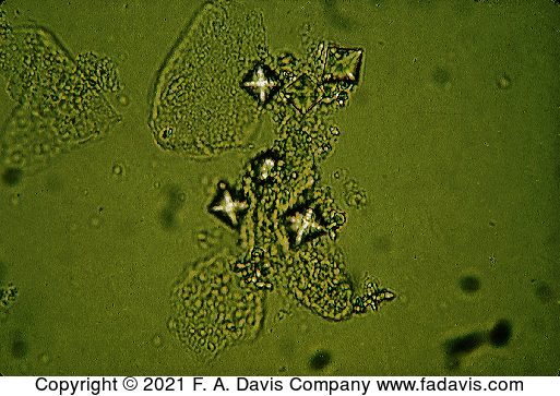 <p>Name this crystal? What is the disease its associated with? what is its ph? normal or abnormal?</p>