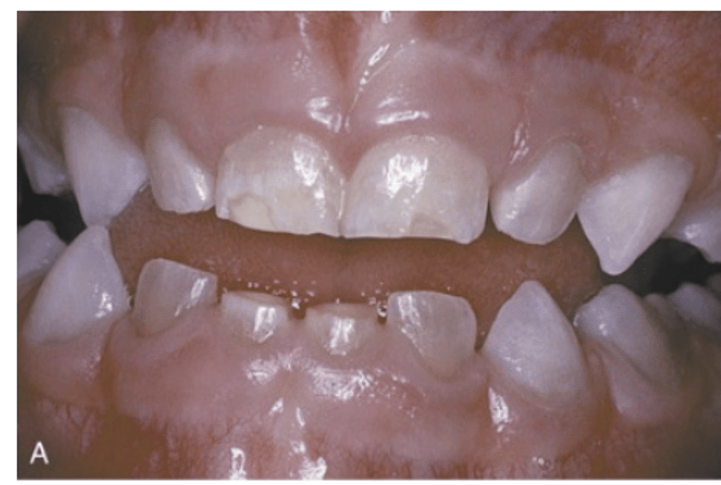 <p>In which types of Osteogenesis Imperfecta are dental alterations more evident?</p>