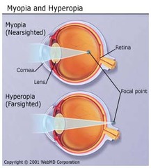 nearsightedness
distant objects appear blurry
light is focused in front of the retina
abnormal curve of the cornea or the shape of the eye