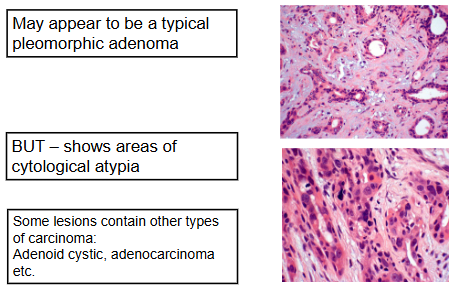 <p>hyperchromatic cells</p><p>dark staining</p><p>mitoses</p>