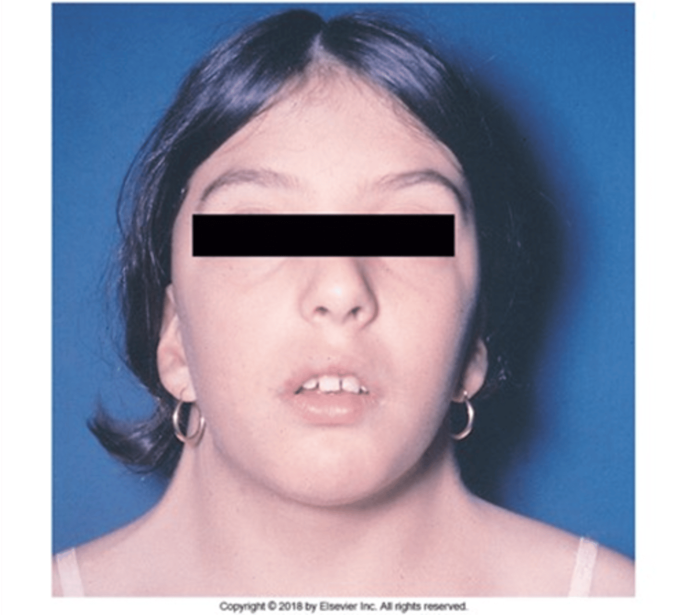 <p>A chromosomal disorder in females in which either an X chromosome is missing, making the person XO instead of XX, or part of one X chromosome is deleted.</p><p>46 chromosone - normal</p><p>45 chromosone -> Turner syndrome</p>