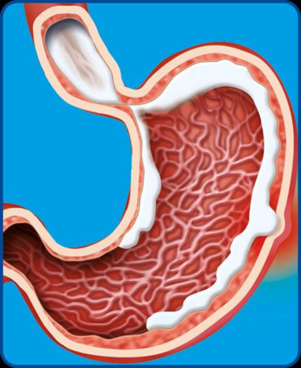 <p>Binds to positively charged proteins in the ulcer base to create a barrier.</p>