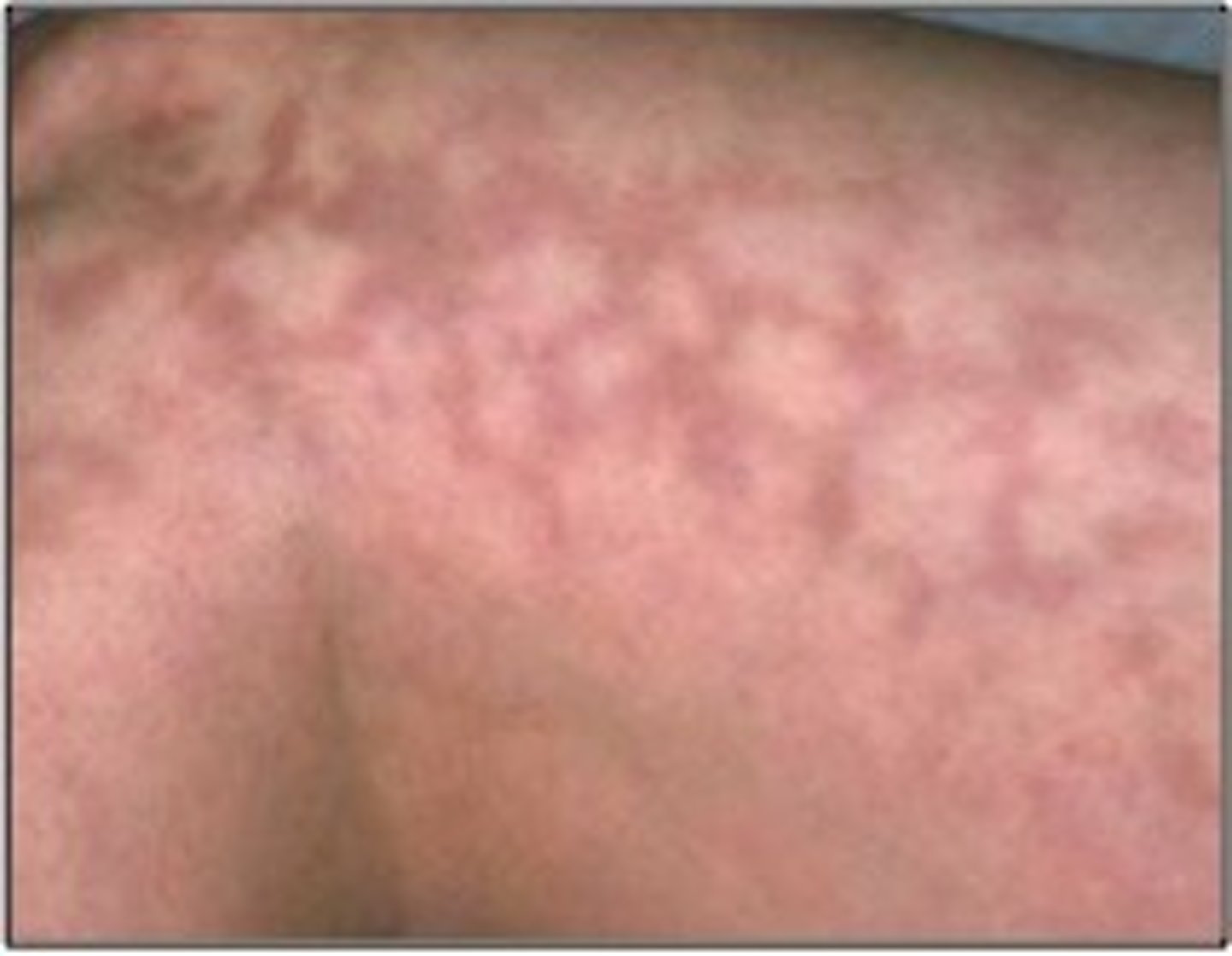 <p>lesions with a "net-like" arrangement</p>