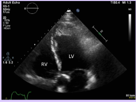 <p>Only one surface is exposed to blood pool; other sides connected to cardiac wall.</p><p>Incidence for embolization and thromboembolic event is lowest.</p>