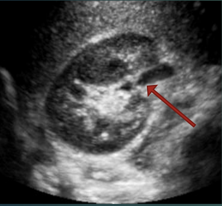 <p>What is the red arrow pointing at?</p><p>TRV RT kidney </p>
