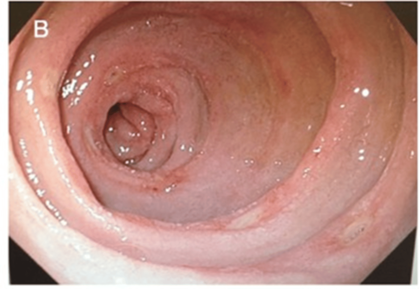 <p>Rare condition characterized by gastrin-producing tumors in the duodenum and/or pancreas that lead to oversecretion of gastrin, which lead to gastric and duodenal ulcers </p>
