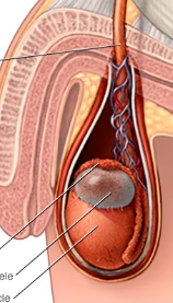 <p><span>= painless fluid filled cyst in the epididymis</span></p>