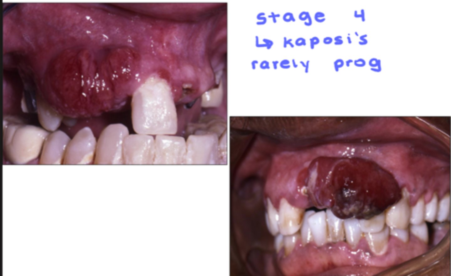 <p>intraoral lesions may resemble kaposi's sarcoma</p><p>- presents with diffuse bone loss</p><p>- involves CNS or GI tract</p><p>usually very aggressive w/poor prognosis</p>