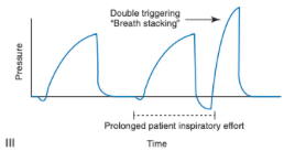<ul><li><p><span>Two delivered breaths separated by an expiratory time less than half the mean expiratory time</span></p><ul><li><p><span>Occurs when a patient's inspiratory effort continues throughout the ventilator's preset I-time and thus remains present after the I-time has been completed</span></p><ul><li><p><span>This prolonged effort triggers another breath</span></p></li></ul></li><li><p><span>End result is the patient receiving a tidal volume twice the desired or preset size</span></p></li><li><p><span>Carries the risk of overdistension and alveolar trauma</span></p></li><li><p><span>May be due to exceptionally high ventilatory demand on the part of the patient, low tidal volumes, an I-time that is too short, or a flow-cycle threshold set too high</span></p></li></ul></li></ul><p></p>