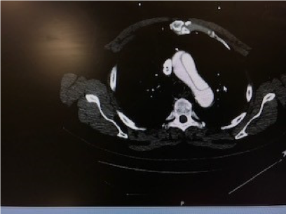 <p>What does this CT scan with IV contrast refer to </p>
