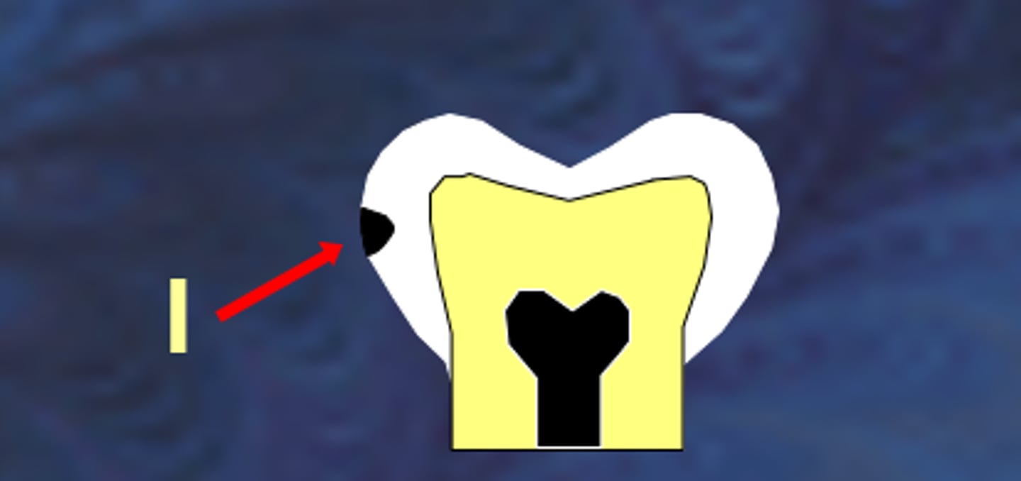 <p>extends less than halfway through enamel</p>