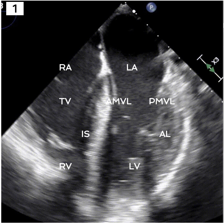 <p>Midesophageal 4 chamber view. </p>