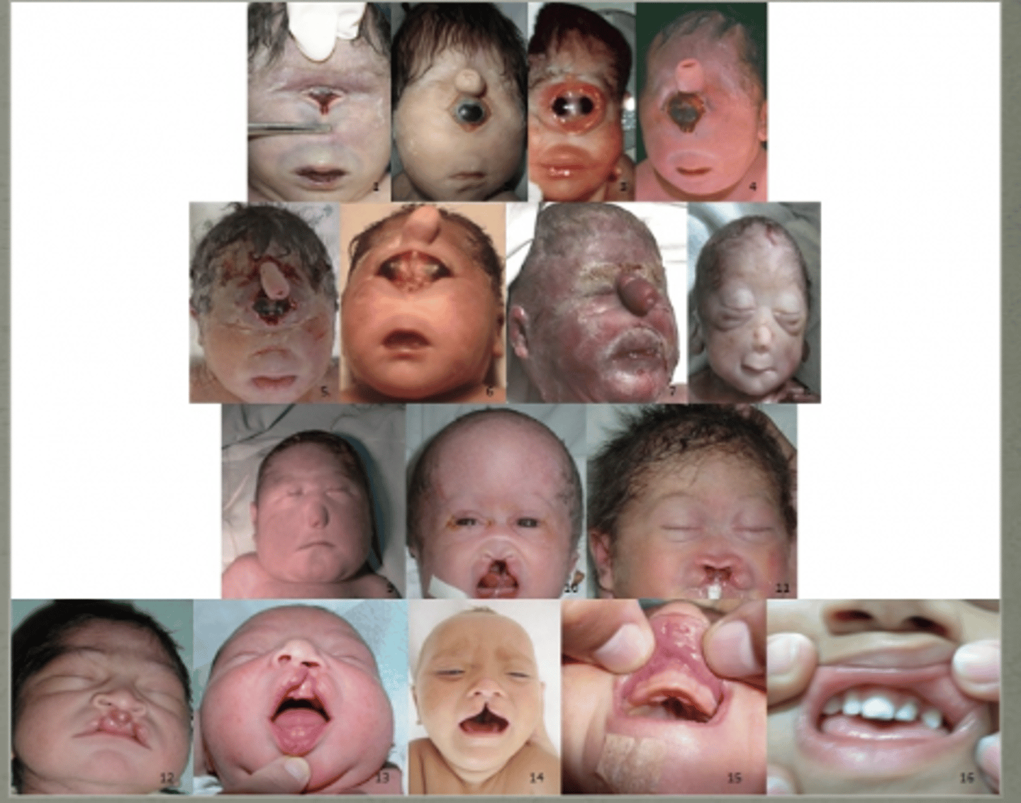 <p>Holoprosencephaly</p><p>(brain does not split correctly)</p>