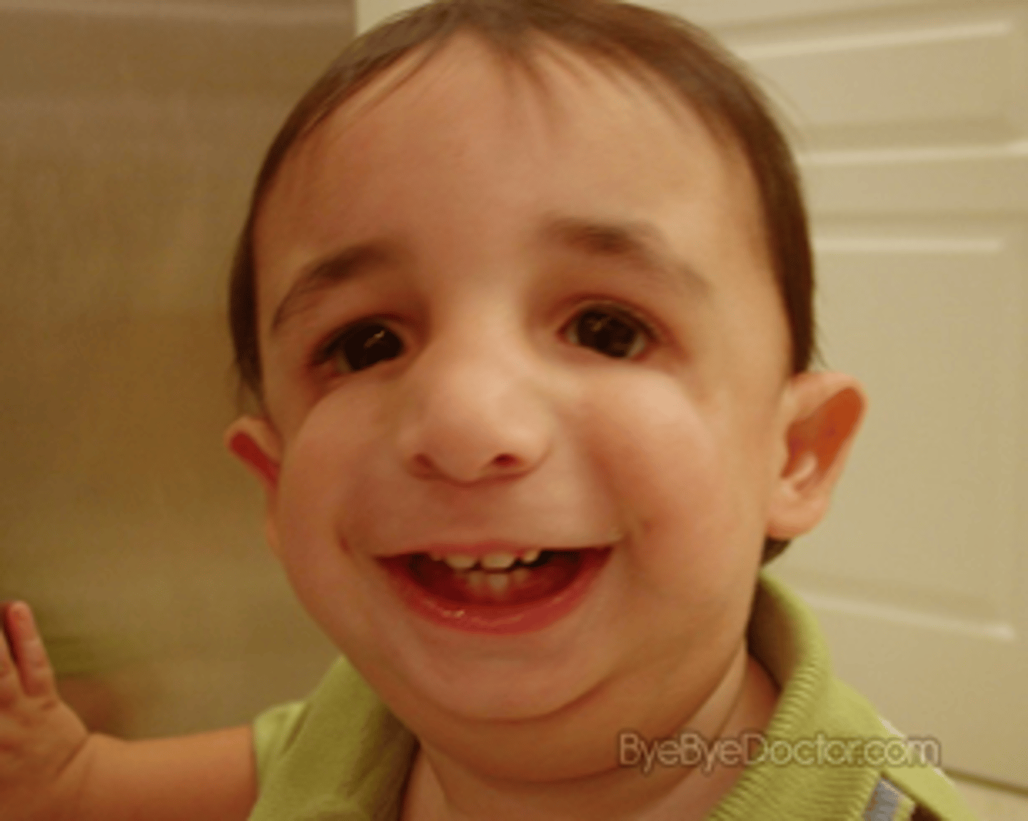 <p>hearing loss and breathing (respiratory) difficulties. Cleft palate ,behavioral anomalies such as microcephaly and psychomotor delay, downward-slanting eyes, a very small jaw and chin, hearing loss, and vision loss</p>