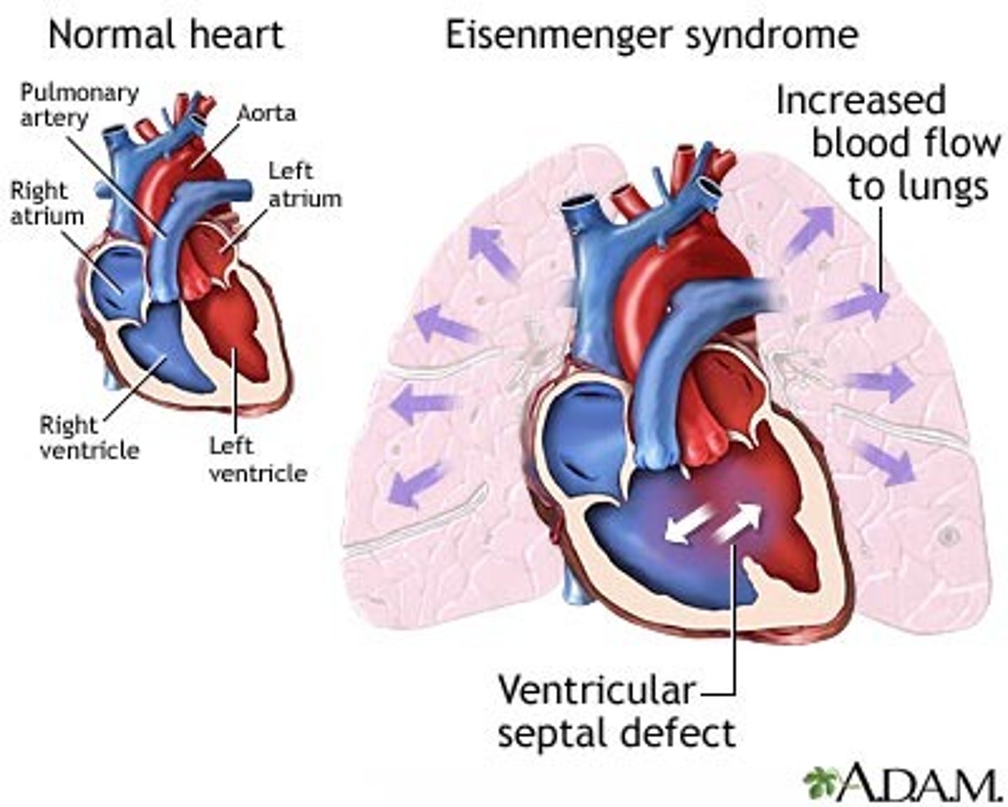 <p>The most dangerous complication of untreated PDA, ASD, or VSD. No cure except lung transplant.</p><p>Any large defect allowing FREE COMMUNICATION between pulmonary and systemic circulations (PDA, ASD, VSD</p><p>Excess blood flow → DAMAGES thin, fragile pulmonary vessels → PULMONARY HYPERTENSION If a large VSD (or other shunt left to right) is left unrepaired, chronically elevated pulmonary blood flow and pressure remodel the pulmonary arteries; pulmonary vascular resistance eventually exceeds systemic, the shunt reverses to right‑to‑left, the child becomes cyanotic, and this is called Eisenmenger syndrome in the context of CHD. </p><p>This is permanent and irreversible pulmonary vasculature damage. </p><p>Definition: Severe pulmonary arterial hypertension with reversal (or bidirectionality) of a congenital shunt, leading to right‑to‑left flow and cyanosis.</p><p>Mechanism: Chronic high pulmonary blood flow and pressure cause intimal fibrosis and remodeling of pulmonary arteries; pulmonary vascular resistance eventually exceeds systemic resistance.</p><p>Key point for exams/clinicals: Once true Eisenmenger physiology is established, the pulmonary vascular disease is considered irreversible, and closing the defect is usually contraindicated—management focuses on PH therapy, avoiding pregnancy, and transplant evaluation.</p>