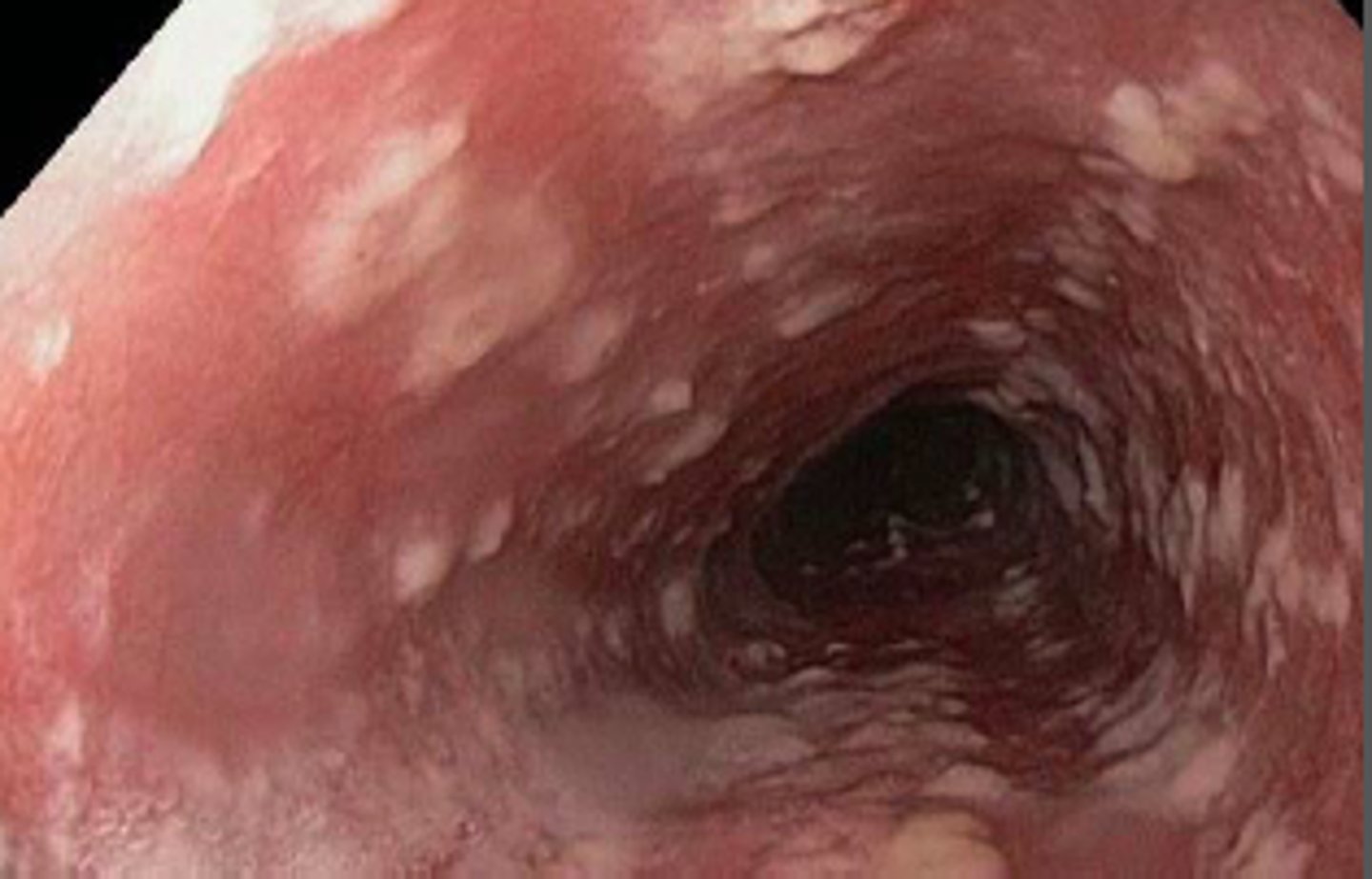 <p>Diagnosis is by EGD with biopsy will demonstrate linear erosions on endoscopy</p>