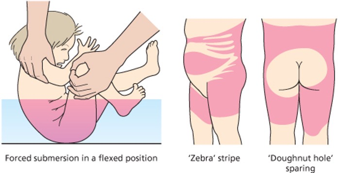 <ul><li><p><span>Forced submersion in a fixed position</span></p><ul><li><p><span>Zebra striped</span></p></li><li><p><span>Doughnut hole sparing</span></p></li></ul></li></ul>