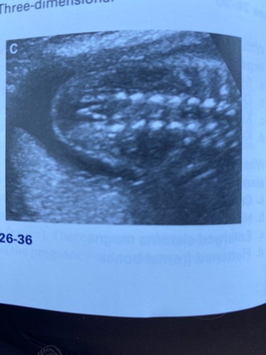 <p>What demonstration is Figure 26-36 of the fetal spine?</p><p>a. Transverse</p><p>b. Coronal</p><p>c. Longitudinal</p><p>d. Three-dimensional</p>