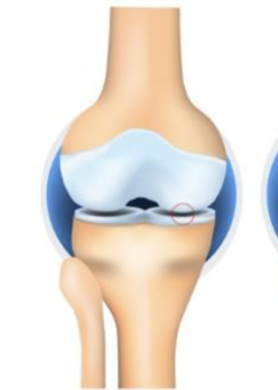<p>Which stage of OA is characterized by possible osteophytic lipping and doubtful JSN</p>