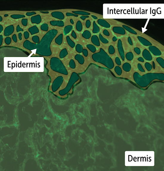 <p>Serology testing for ELISA and IF test - test for <strong>IgG abs for desmoglein 1 and 3 and against circulating epithelial antigens</strong></p><p>Biopsy to test <strong>lesions and lesion around skin — </strong>biopsy includes histology and direct IF</p>