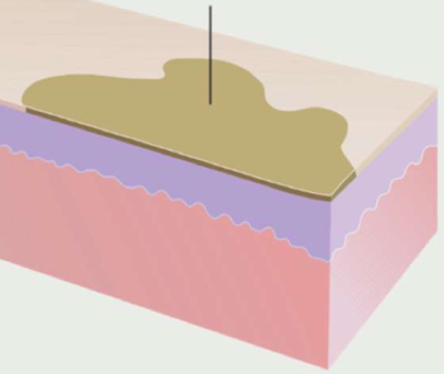 <p>¿lesión?</p><p>¿primaria o secundaria?</p>